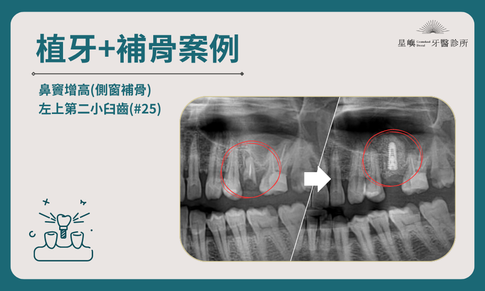 植牙＋補骨-1｜鼻竇增高術｜左上第二小臼齒(#25)
