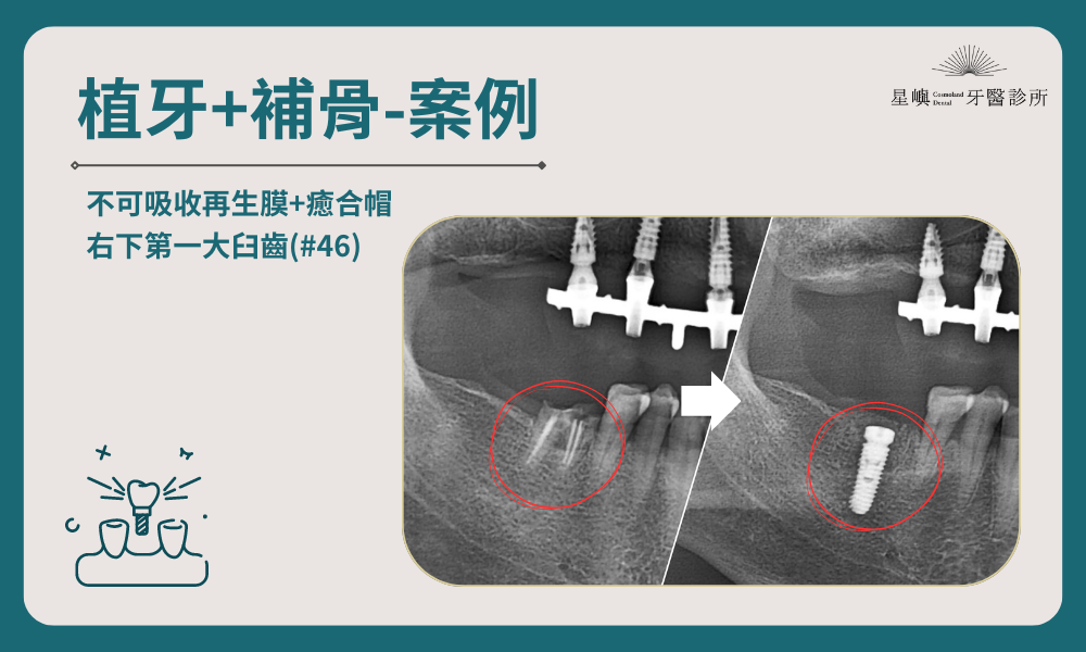 植牙＋補骨-2｜右下第一大臼齒(#46)