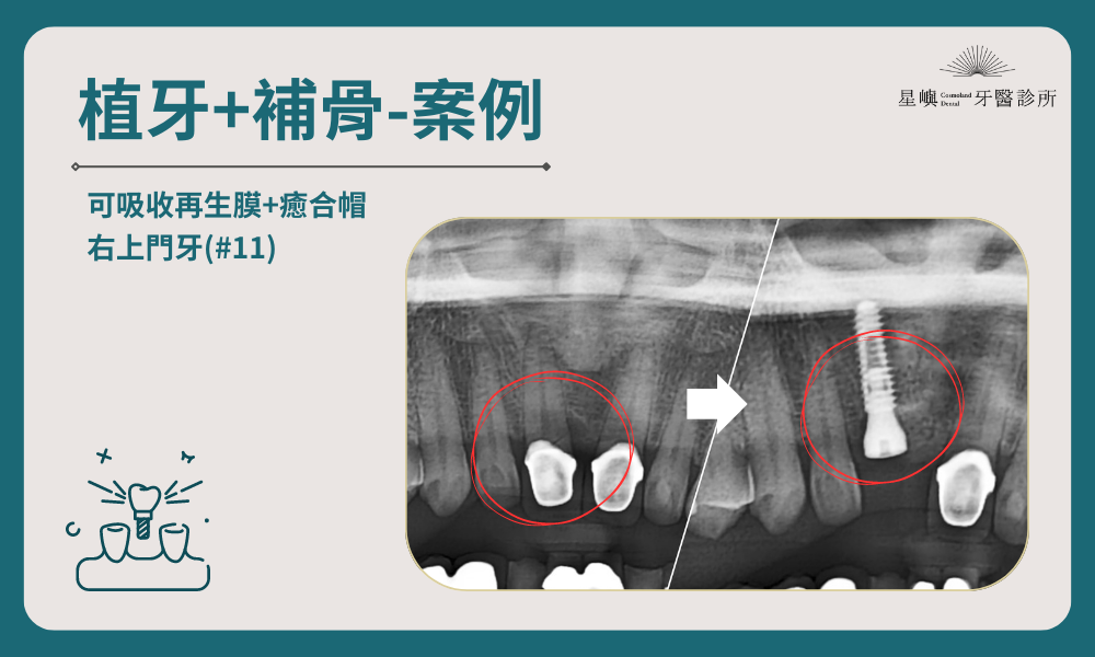 植牙＋補骨｜右上門牙(#11)